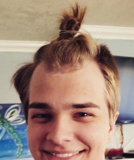 A photograph of a balding young male with traction alopecia caused by wearing a tight top knot hairstyle