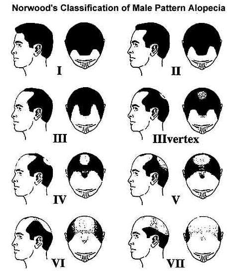 A very-useful illustration of the Norwood-Hamilton scale used to measure the progression of male pattern baldness